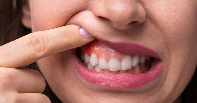 Áp xe răng là bệnh lý nguy hiểm