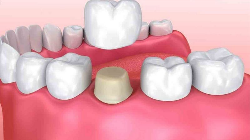 Tìm hiểu về bọc răng sứ