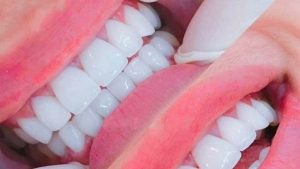Lợi ích khi bọc sứ cho răng