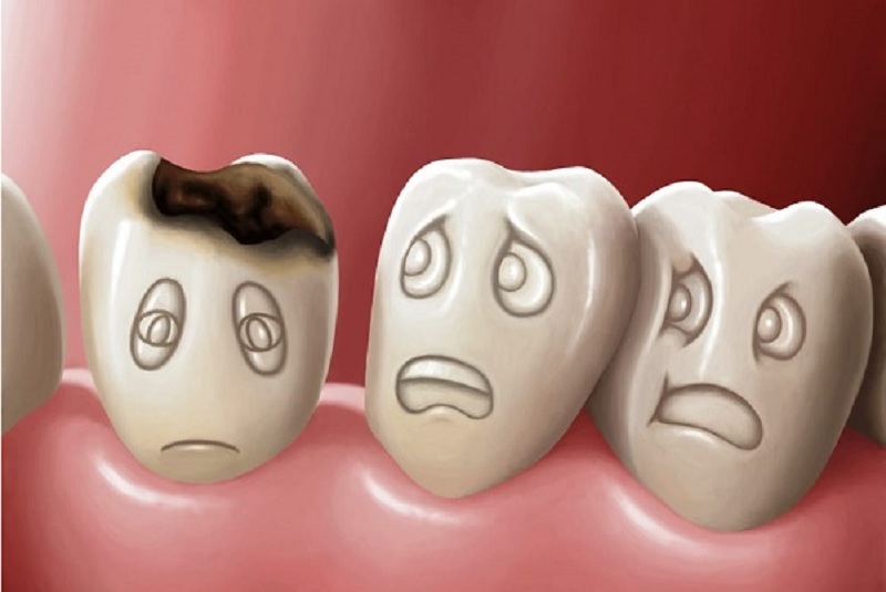 Chữa sâu răng bằng lá bàng non đun sôi để nguội là biện pháp giảm đau răng tạm thời