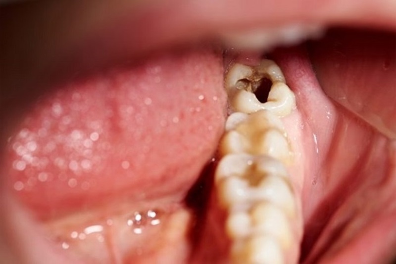 Sâu răng là một trong những nguyên nhân gây đau răng hàm
