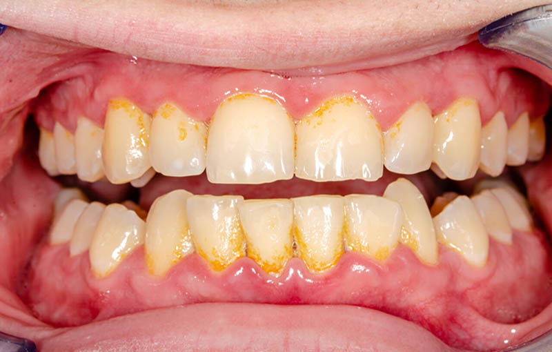 Cao răng tích tụ lâu ngày là một trong những nguyên nhân gây đau răng khi uống nước lạnh