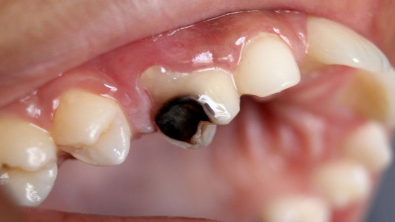 Đau răng nổi hạch cổ nếu bị nặng có thể gây mất răng