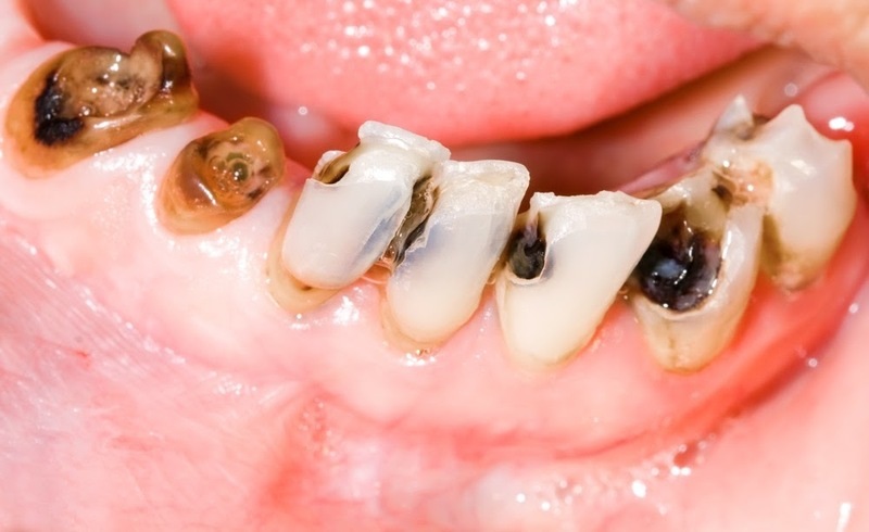 Khi bị sâu răng, bạn sẽ không tránh khỏi những cơn đau đớn, khó chịu