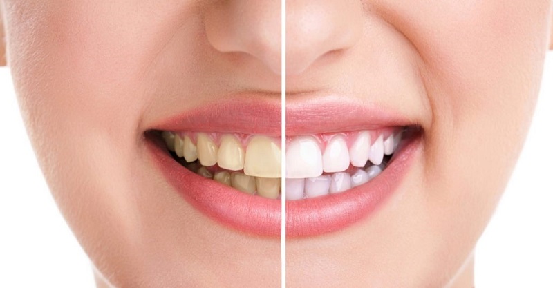 Cao răng hay còn gọi là vôi răng