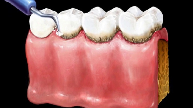 Lấy vôi răng giúp hạn chế tình trạng viêm nướu, sâu răng