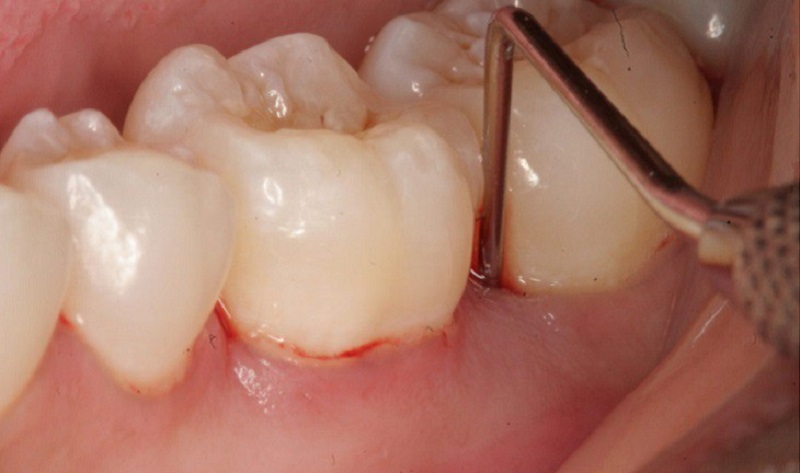 Lấy vôi răng xong vẫn có thể ăn nhai bình thường