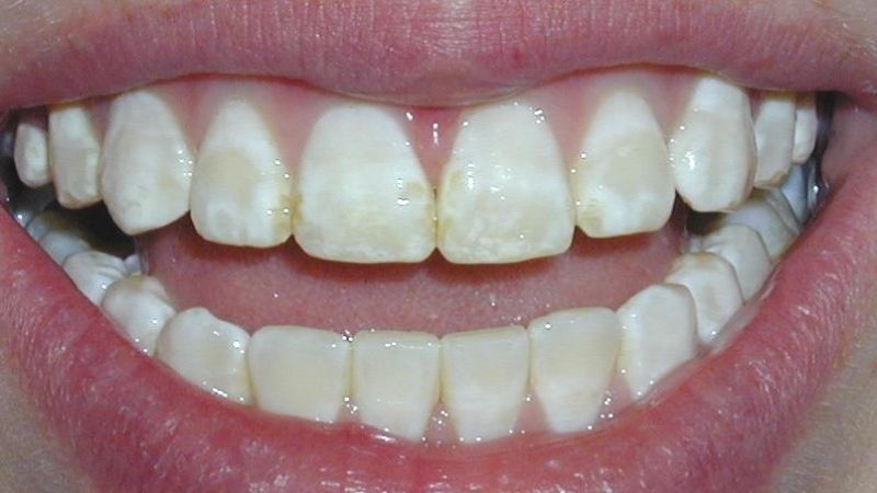Các dấu hiệu cho thấy men răng đã bị hỏng