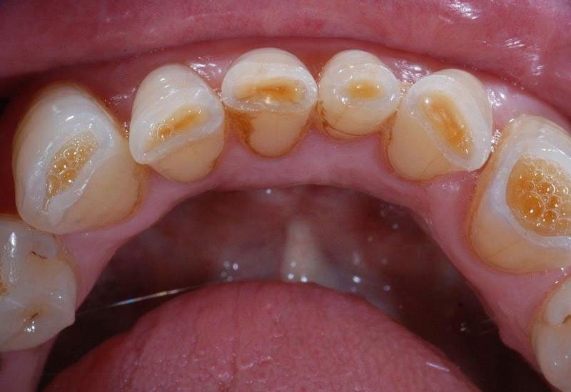 Yếu tố di truyền và một số bệnh lý cũng có thể dẫn đến men răng bị mòn