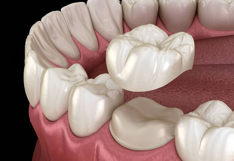 Hình ảnh mô phỏng kỹ thuật bọc răng sứ
