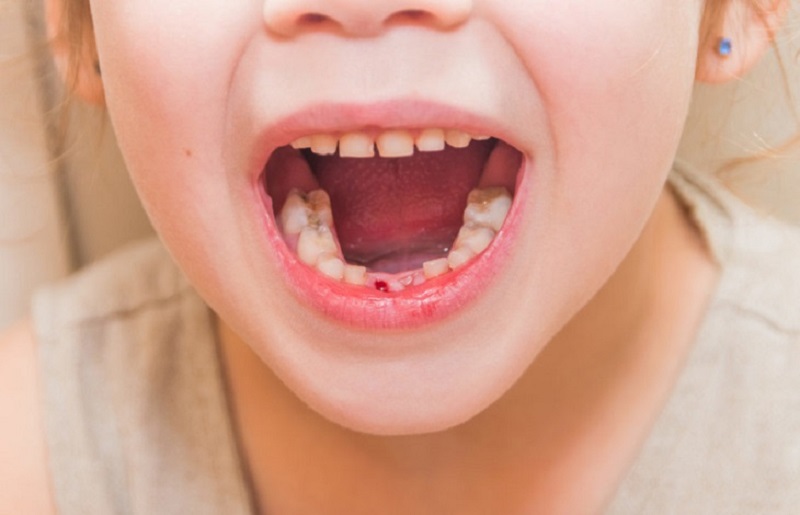 nhổ răng sữa cho bé Răng sữa sẽ được thay thế bằng răng vĩnh viễn khi trẻ đủ tuổi thay răng