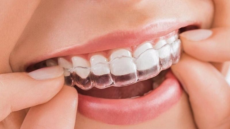 Chỉnh nha giúp bạn có hàm răng đẹp hơn