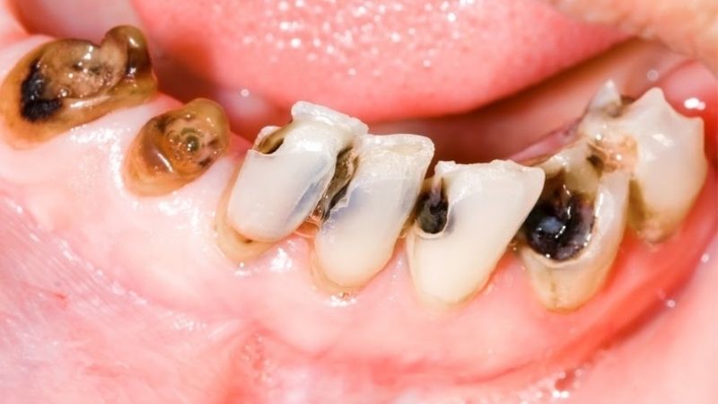 Tìm hiểu về sâu răng