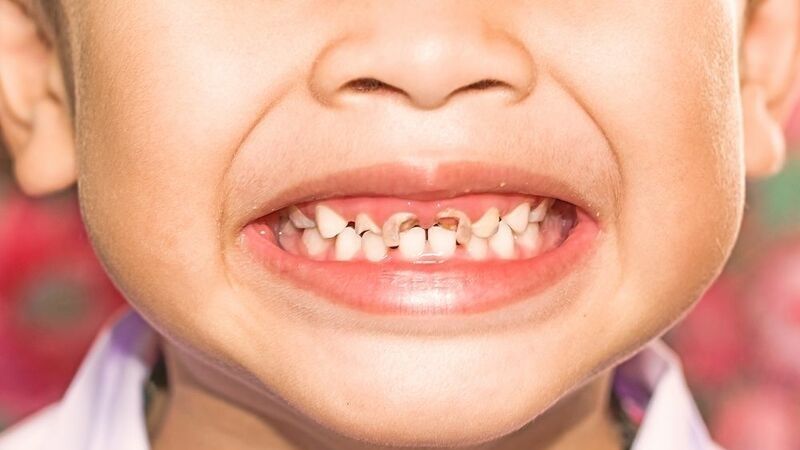 Răng sâu làm rụng răng nhanh chóng
