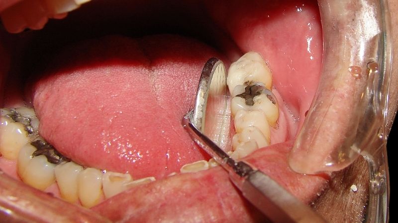 Sâu răng gây mất thẩm mỹ 