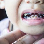 Sún răng cửa ở trẻ em