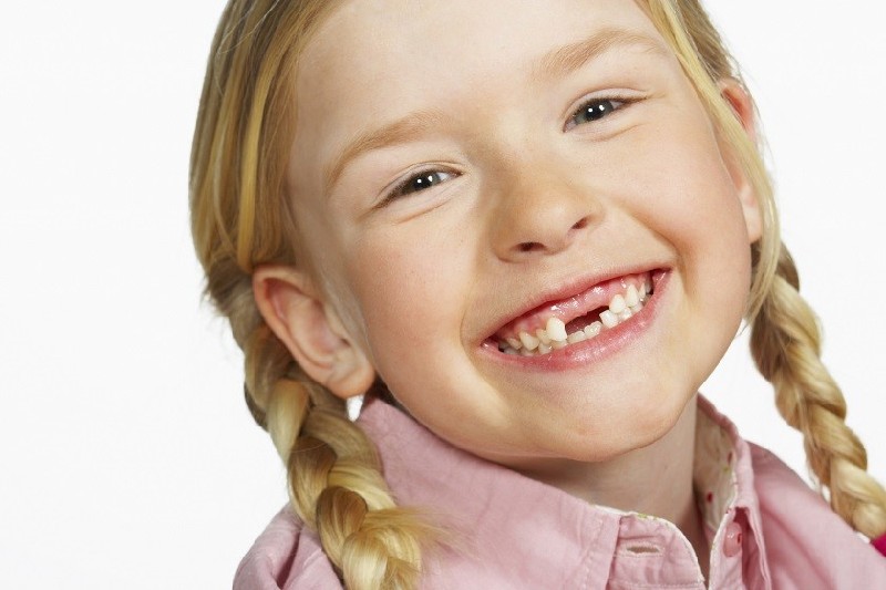Sún răng cửa là một bệnh lý về răng miệng, làm tiêu dần đi răng sữa của trẻ