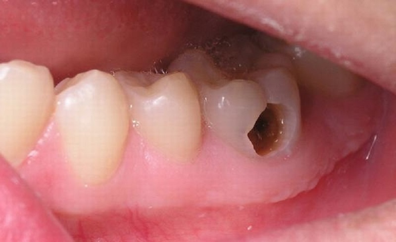 Franrogyl giúp làm giảm đau nhức răng do sâu răng