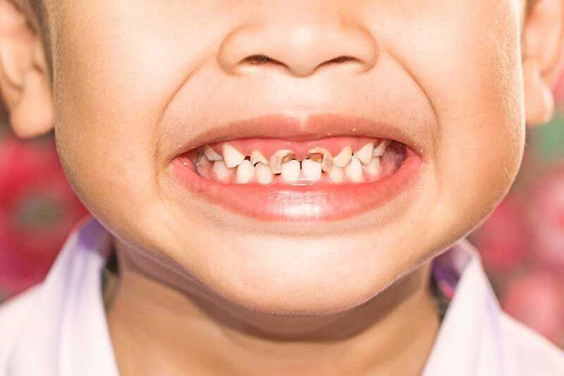 Sâu răng làm trẻ bị đau nhức, khó chịu