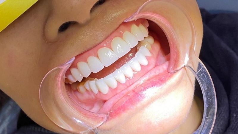 Ưu điểm của việc sử dụng răng sứ