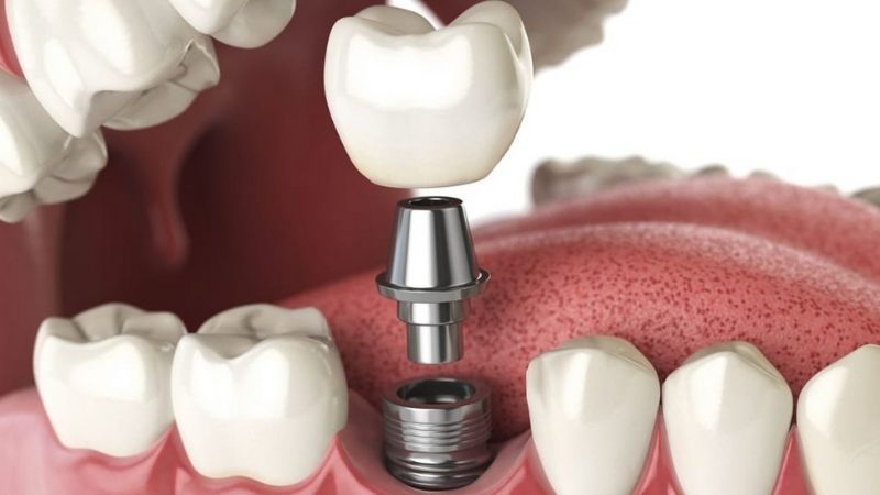 Xu hướng trồng răng implant đang rất phổ biến hiện nay