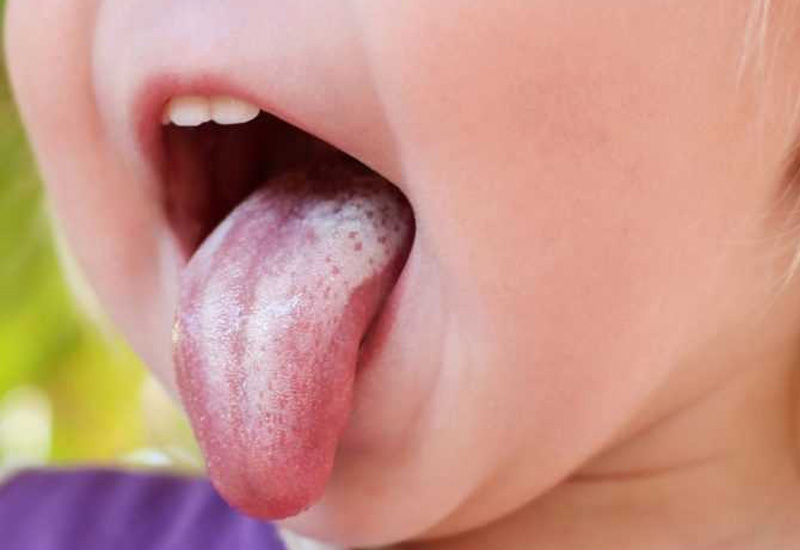 Ở giai đoạn đầu, trên lưỡi trẻ sẽ xuất hiện những đốm trắng nhỏ, khá khó nhận biết