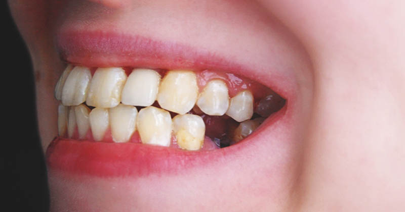 Mất răng là một trong những biến chứng nghiêm trọng của viêm chân răng