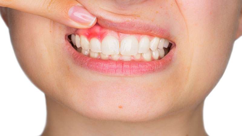 Viêm chân răng là bệnh lý khá phổ biện hiện này
