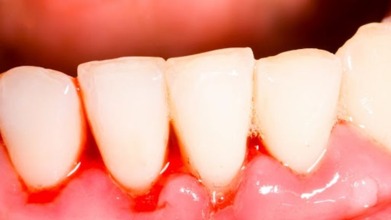 Chân răng dễ bị chảy máu