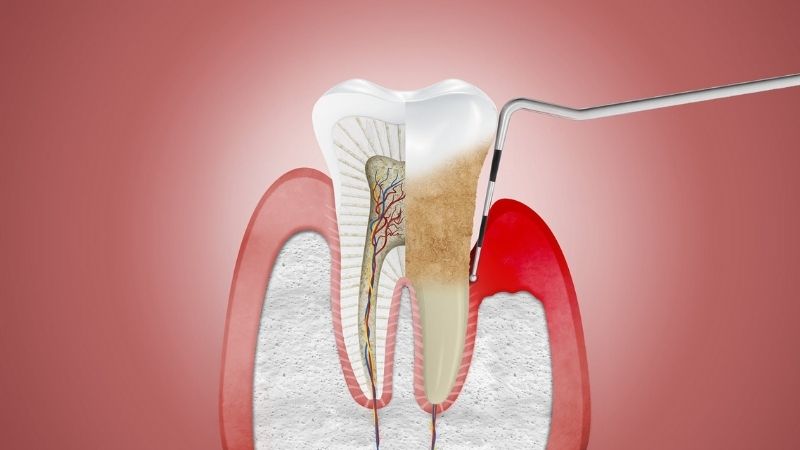Người bệnh có thể bị viêm tủy răng