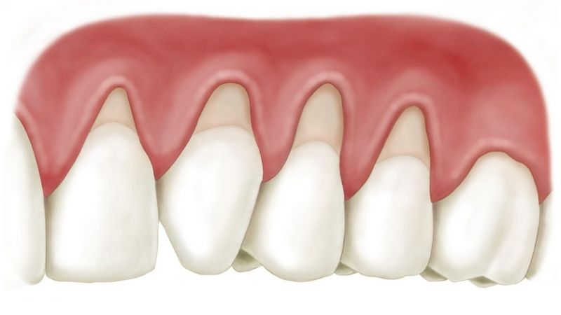 Răng xuất hiện kẽ hở do tụt lợi