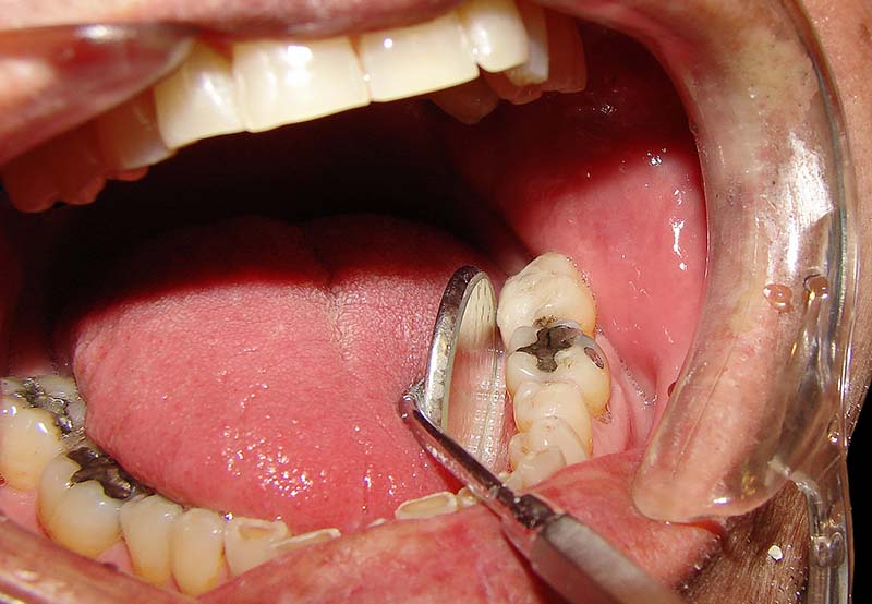 Đau răng dẫn đến đau đầu có thể do sâu răng, nhiễm trùng răng