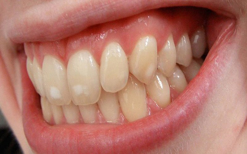 Nên bọc răng sứ khi răng bị nhiễm màu nặng