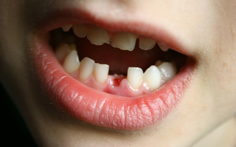 Người bị mất răng nên sử dụng phương pháp bọc sứ