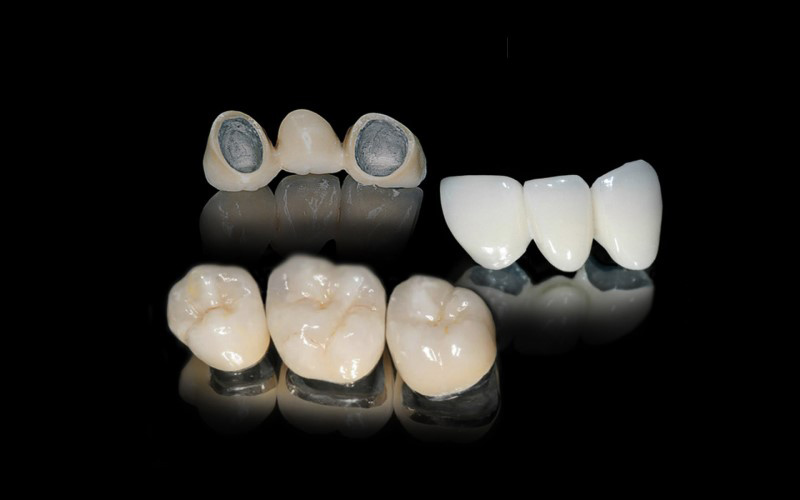 Răng sứ kim loại được nhiều người lựa chọn