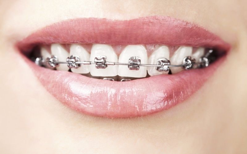 Niềng răng là phương pháp nha khoa thẩm mỹ mang lại nụ cười tự tin