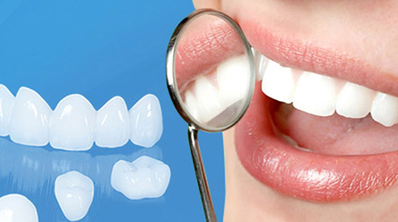 Bọc răng sứ là giải pháp thẩm mỹ nhanh chóng, hiệu quả
