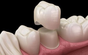 Quy trình bọc răng sứ đúng chuẩn đảm bảo tuổi thọ sử dụng cho răng