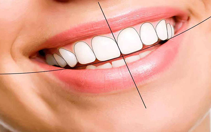 Trước khi bọc răng sứ bạn cần tìm hiểu kỹ càng về phương pháp