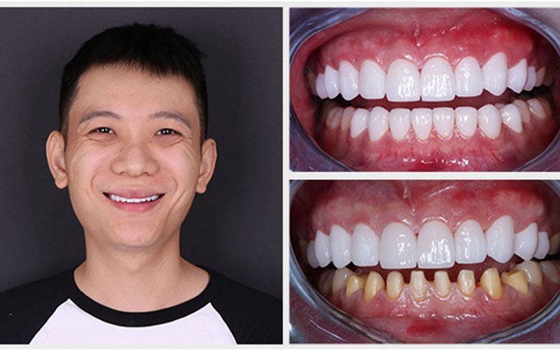 Hình ảnh so sánh sự thay đổi trước và sau khi bọc răng sứ
