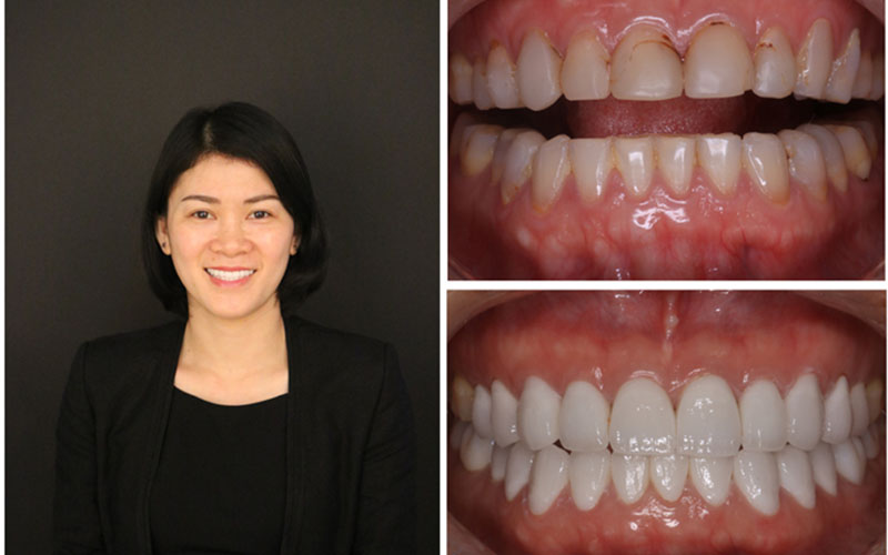 Hình ảnh trước và sau khi bọc răng sứ thẩm mỹ