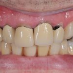 Bọc răng sứ bị cộm có sao không, xử lý như thế nào?