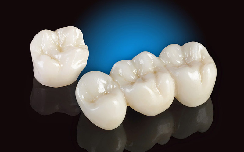 Răng sứ toàn sứ có độ bền cao hơn so với răng sứ kim loại