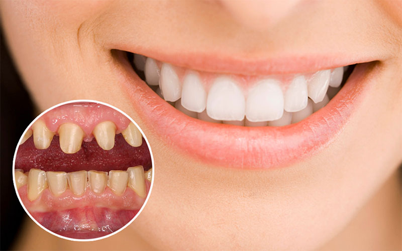 Thời gian bọc răng sứ thường chỉ mất từ sau 2 đến 3 lần hẹn