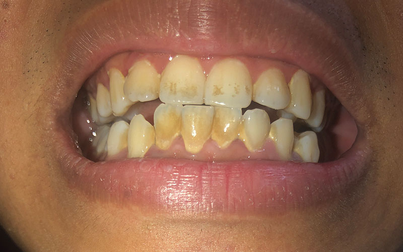 Người bị răng ố vàng nên bọc răng sứ để có được hàm răng thẩm mỹ