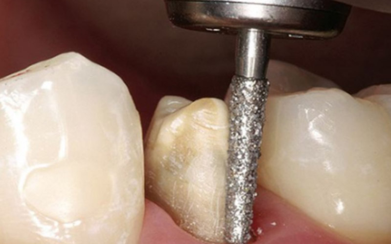 Mài răng bọc sứ là bước quan trọng của quá trình bọc răng sứ