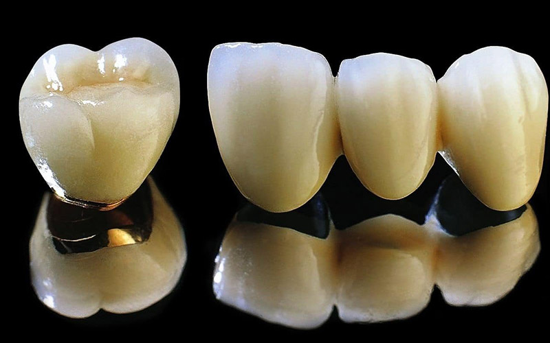 Răng sứ kim loại có độ bền không cao bằng sản phẩm hoàn toàn bằng sứ
