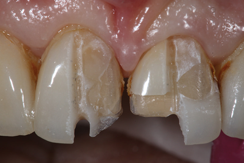 Tình trạng răng bị nứt, vỡ, gãy và nhiễm màu khi dùng dán sứ Veneer giá rẻ