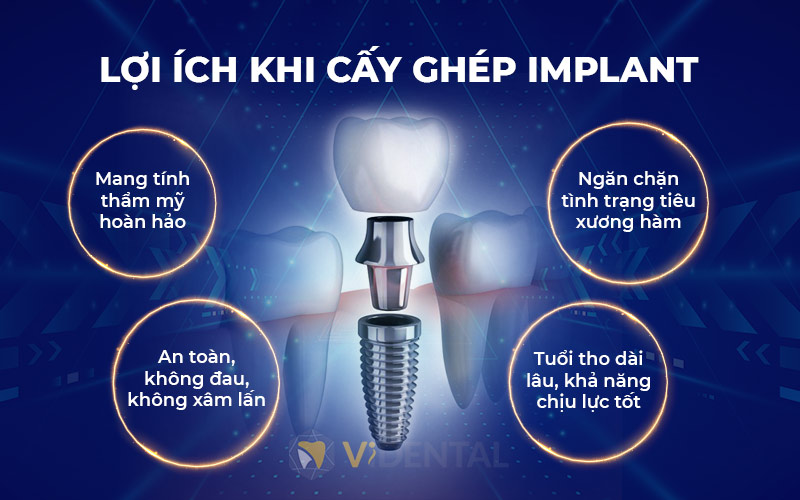 Rất nhiều lợi ích hấp dẫn khi trồng răng implant 