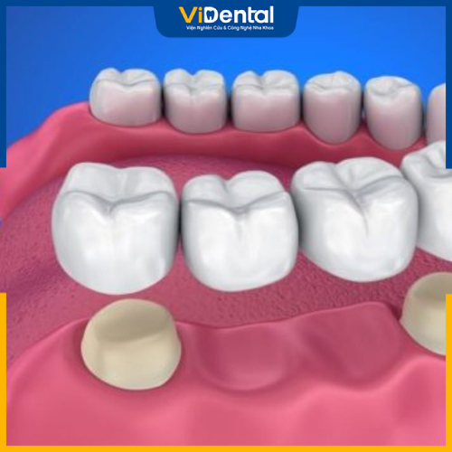 Quy trình bọc răng sứ đúng chuẩn tại ViDental